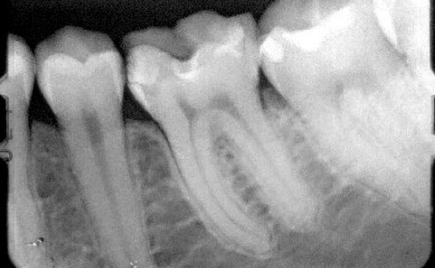 Implantes prótesis fija