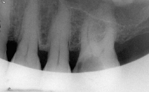 Implantes prótesis fija