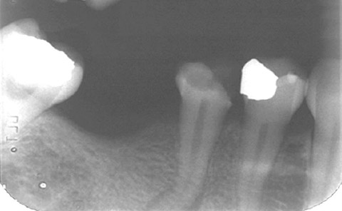 Implantes prótesis fija
