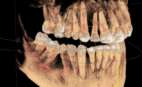 Implantes prótesis fija