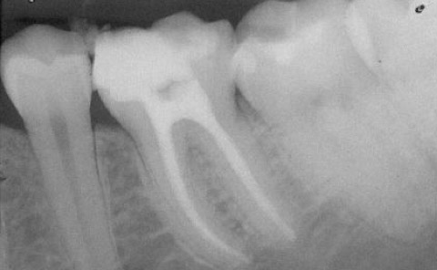 Implantes prótesis fija