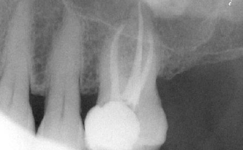 Implantes prótesis fija