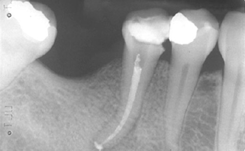 Implantes prótesis fija