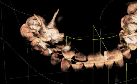 Implantes prótesis fija