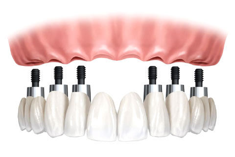 Implantes prótesis fija