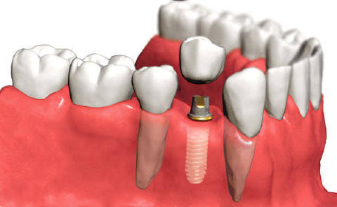 Implantes prótesis fija